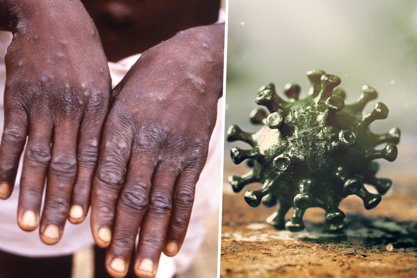 Die WHO ruft wegen Affenpocken, inzwischen „Mpox“ genannt, ihre höchste Alarmstufe aus. Die Krankheit gilt nun als „gesundheitliche Notlage internationaler Reichweite“. Grund dafür ist eine neue Virusvariante aus Afrika. Das Bild ist eine Montage aus zwei Fotos. Links sieht man die Hände einer Person, die mit Affenpocken infiziert ist, rechts sieht man ein Symbolbild für Viren.